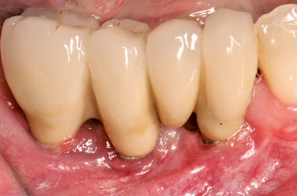 Abb. 1: Biofilm-assoziierte Mukositis.