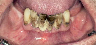 Abb. 1: Ausgangssituation UK labial.