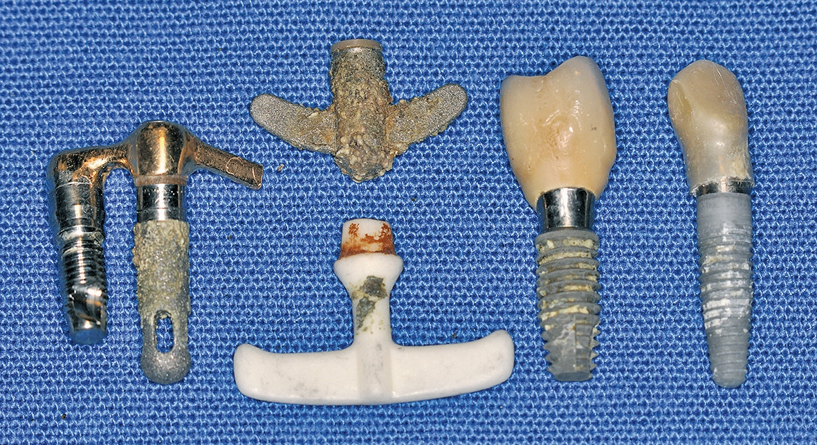 Abb. 2: Starker Konkrementbefall an den Implantaten selbst.