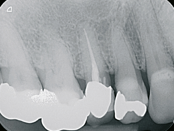 Abb. 1: Endodontisch vorbehandelter Zahn 14 soll implantatprothetisch ersetzt werden.