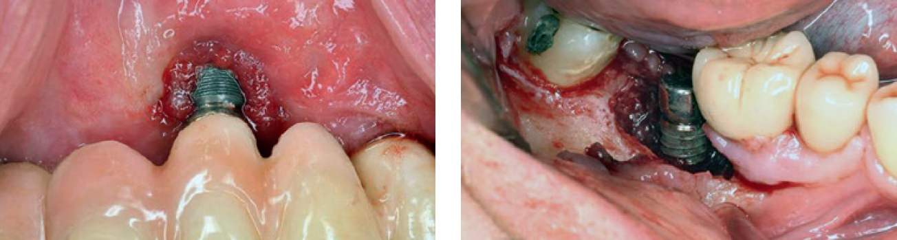 Abb. 1 u. 2: Beispiele von massiven Knochendefekten im Front- und im Seitenzahnbereich bedingt durch Periimplantitis.