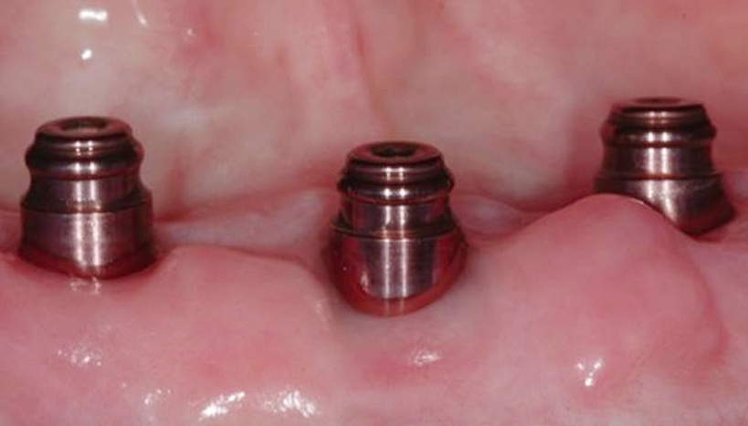 Eingebrachtes LOCATOR R-Tx-System. © Mark Montana, DDS, USA.