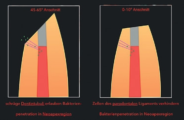 Abb. 1: Auf der linken Seite lässt die starke Anschrägung der Wurzelspitze im Kanal vorhandene Bakterien durch die schräg geschnittenen Dentintubuli in den Periapex. Aus der rechten Seite verhindert das parodontale Ligament auf der unbeschädigten Wurzeloberfläche bei geringem Bevelgrad das ungehinderte Austreten von intrakanalären Bakterien.