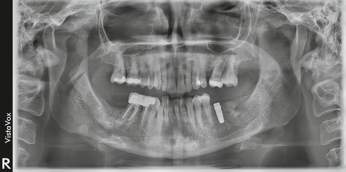 Flexibel im Einsatz: Neben DVT-Aufnahmen lassen sich innerhalb von sieben Sekunden zeichenscharfe 2D-Orthopantomogramme erstellen (hier: Abschlussbild nach Implantatinsertion regio 36.)