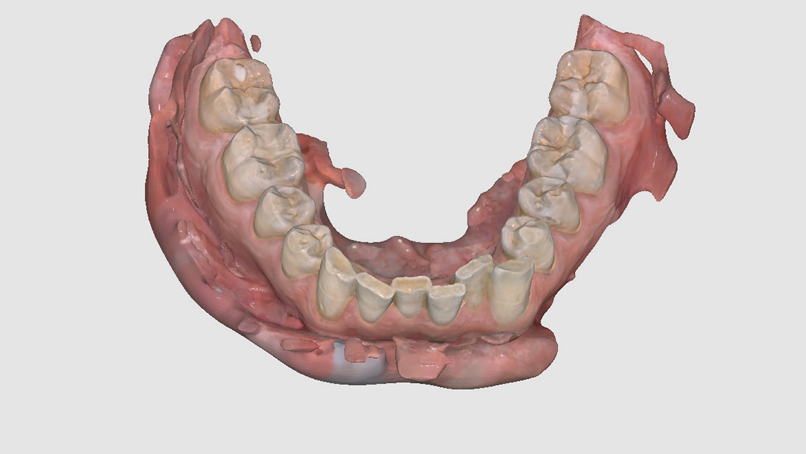 Abb. 1: Unterkiefer-Intraoralscan.