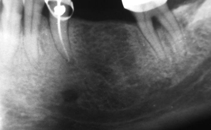 Abb. 1: Wenn auf einem OPTG das Foramen mentale deutlich über dem Kanal liegt, so liegt ein weitführender „Loop“ nach anterior vor! Beim Bezahnten im anterioren Bereich sollte man daher 2 mm mesial vom Foramen bleiben, ebenso beim unbezahnten Patienten, allerdings kann man hierbei durch den Loop bohren und auch implantieren, da durch den Loop-Anteil nur die vorderen Zähne innerviert werden.