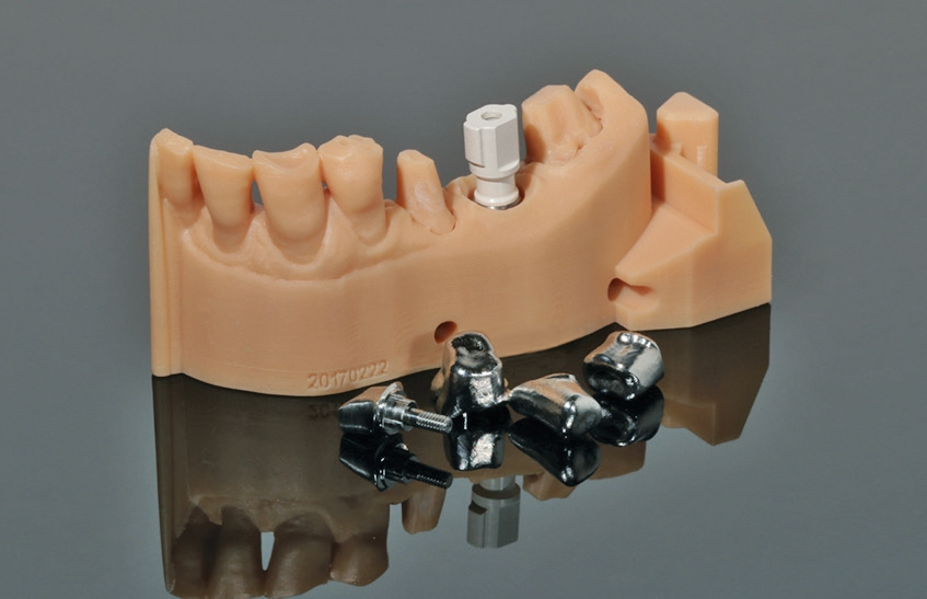 Abb. 2: Der Scanbody gibt die genaue Position und Ausrichtung des Implantats wieder und dient als Platzhalter…