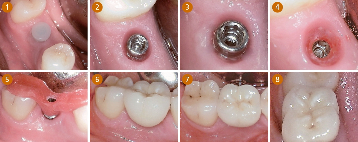 Abb. 1-8: Bei Spätimplantaten einer Einzelzahnversorgungen warten wir 6-8 Wochen, um das Implantat von der Primärstabilität in die sekundäre Osseointegrationsphase zu überführen. Sofern ein Gingiva-Clix (Abb. 1) über den Shuttle gesteckt wurde (aus PEEK für ein besseres Emergenzprofil) nimmt man ihn ab, entfernt die kleine Halteschraube, die den Shuttle mit dem Implantatkörper verbindet, löst danach mit dem ‚Shuttle-Lifter’-Instrument erstmalig den Shuttle vom Implantat, steckt das vom Labor kommende Abutment (mit oder ohne ‚Führungsschlüssel’ – Abb. 5) in den Doppelkonus, verschraubt mit der gleichen Halteschraube, die man zuvor entfernt hat, das Abutment mit 25 Ncm, verschließt den Schraubkanal mit Cavit oder Teflonband und zementiert die Krone.