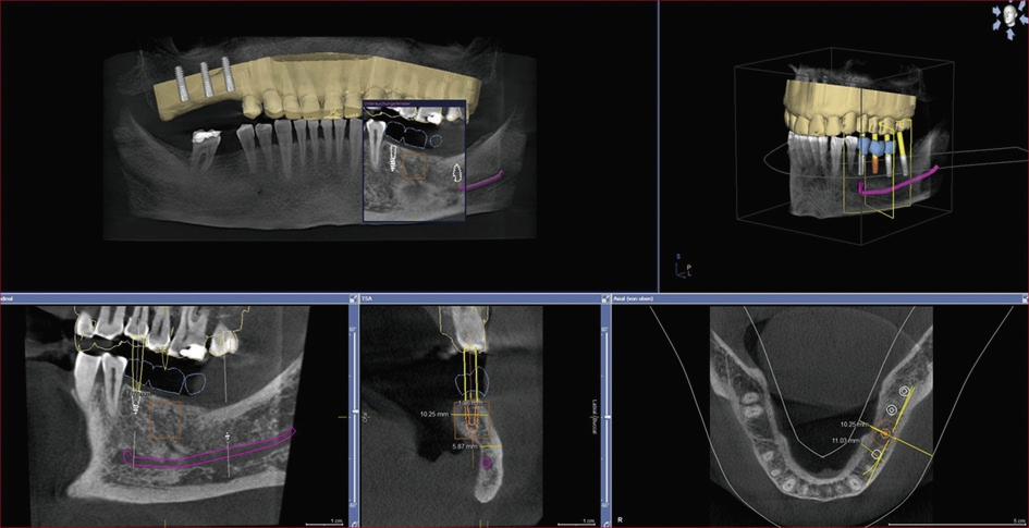 Dentsply Sirona hat bei der Implantatversorgung alle Arbeitsabläufe aufeinander abgestimmt.