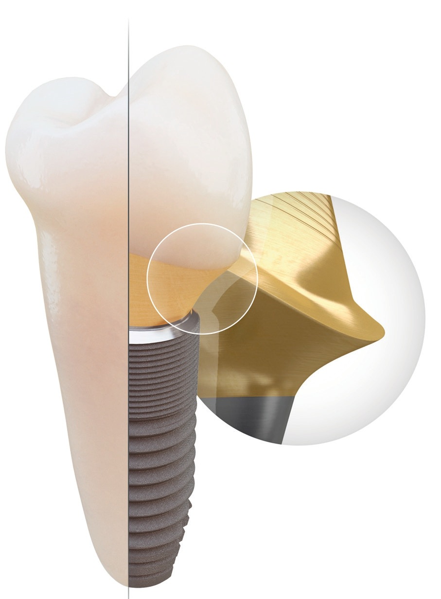 Wurzelgleicher Übergang zwischen Implantat und Zahnkrone.