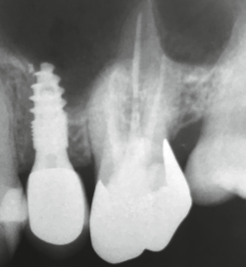 Abb. 1: Ausgangssituation Zahn 26.