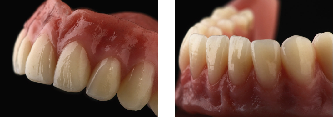 Abb. 1a u. b: Patientenarbeit von ZTM Franz Hoppe (Dental Labor Kock, Wallenhorst) mit Verwendung der neuen Frontzahnlinie VITAPAN EXCELL. Der dreidimensionale, anatomische Schichtaufbau und natürliche Oberflächentexturen sorgen für ein natürlich anmutendes Farb- und Lichtspiel.