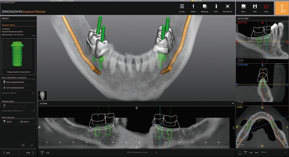 Abb. 1: Planung der Implantatposition mithilfe von DICOM-Daten und einer zuvor durchgeführten Zahnaufstellung in Region 36, 35, 45 und 46. Die Schnittansichten der 3DRöntgenbilder helfen unter Berücksichtigung der Knochenstruktur, die bestmögliche Implantatposition in ästhetischer und funktionaler Hinsicht zu finden.