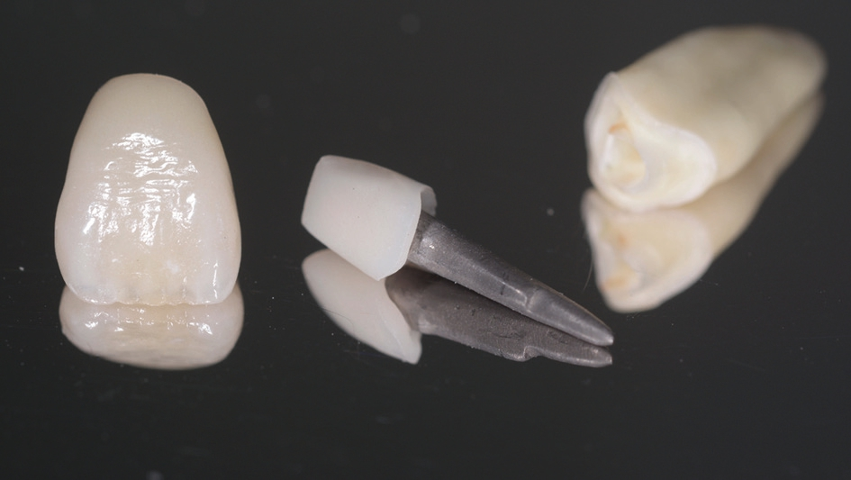 Der Press-on-Metal-Post vereint zwei bewährte Materialien zu einem Hochleistungsprodukt.