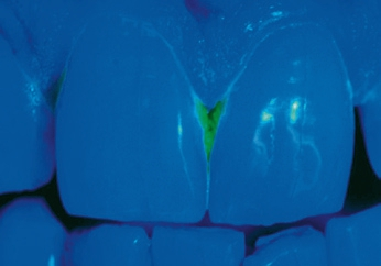 Abb. 1: Bakterieller Biofilm erhöht das Gingivitis- und Kariesrisiko. Anfärben mit Plaque Test von Ivoclar Vivadent macht bakteriellen Belag unter Blaulicht sichtbar. (Bild: Dr. N. Bartling)