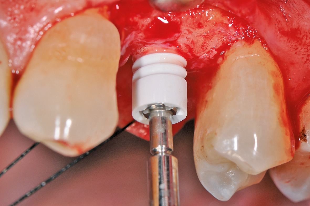 Implantatinsertion mit formschlüssigem Eindrehinstrument.