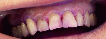 Abb. 1: Ausgangssituation: geschwollene Gingiva und unzureichende Mundhygiene durch Morbus Parkinson bedingte eingeschränkte Motorik.