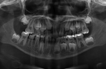 Abb. 1: Panoramaschichtaufnahme bei einem 10-jährigen Jungen mit Down-Syndrom: röntgenologisch erkennbare Nichtanlagen in regio 12, 22, 31, 41.