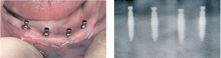 Abb. 1 und 2: Diese vier „Minis“ (Champions-Implants) mit Durchmesser 3,0 mm und Länge 10 mm wurden im Rahmen des einjährigen CITC Curriculums von einer jungen Kollegin bereits in der 1. Woche in eigener Praxis inseriert und prothetisch in Sofortbelastung versorgt.