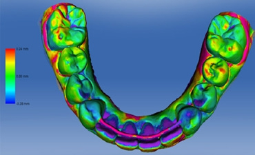 Abb. 1: Differenzanalyse durch Überlagerung von zeitlich versetzten Intraoralscans. Exakte räumliche und zeitliche Erfassung von Erosion, Abrasion, Abplatzungen, Zahnwanderungen, gingivale Rezessionen und Weichgewebeveränderungen.