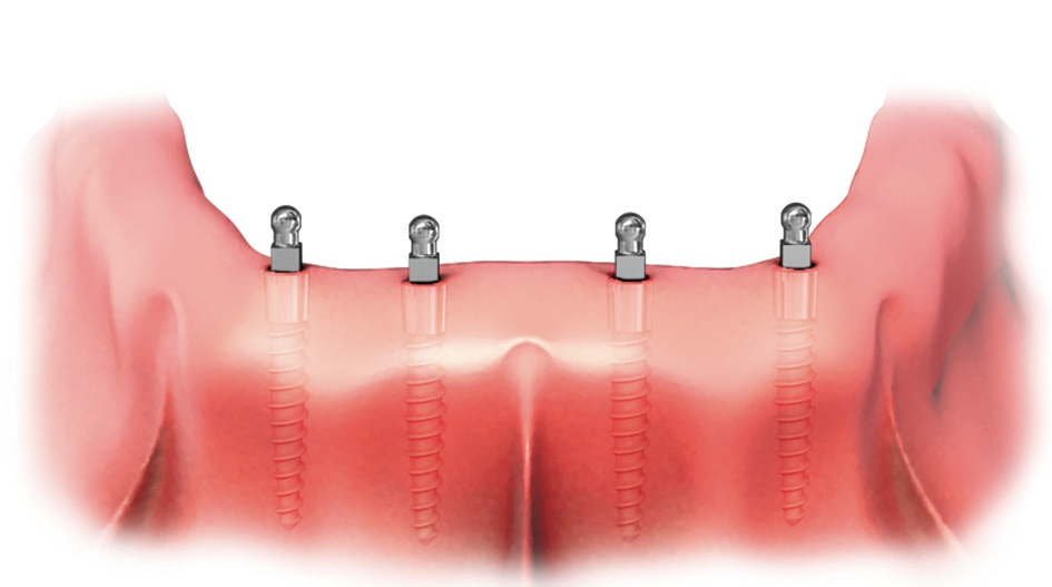 Abb. 1: Wissenschaftlich gut abgesichert: die Stabilisierung einer Unterkieferprothese …