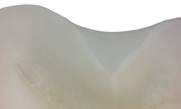 Abb. 1: Dichter Verschluss der Fissur; REM-Aufnahme (Bild: M. Hauner-Westphal).