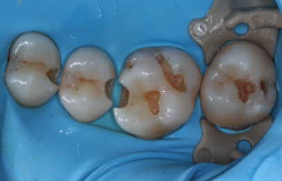Abb. 1: Interproximale Karies wurde entfernt und anschließend die proximale Wand mit G-ænial® Universal Injectable (Farbe A2) aufgebaut.