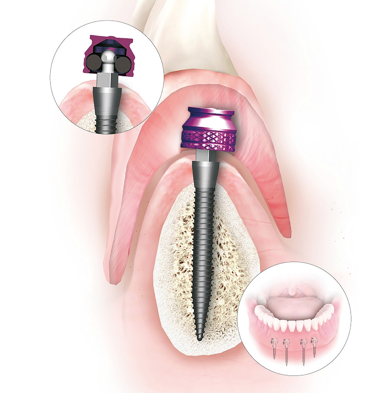 Funktionsprinzip des Therapiekonzeptes der condent GmbH mit MDI Mini-Implantaten.