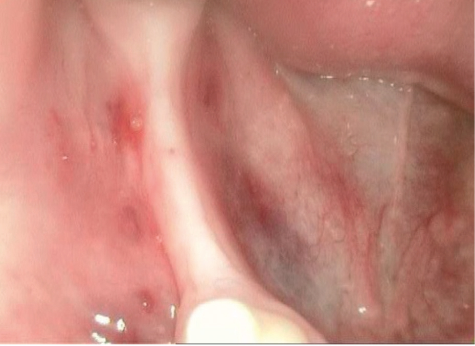 Abb. 1: Volumenveränderung des Alveolarfortsatzes nach Extraktion