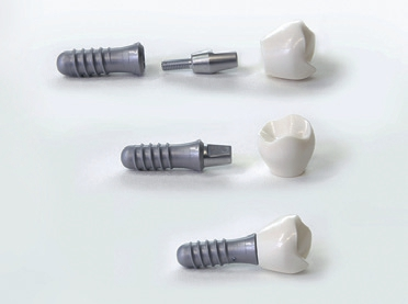 Auch die Beschaffenheit der Implantatoberfläche ist für die Einheilung maßgeblich.