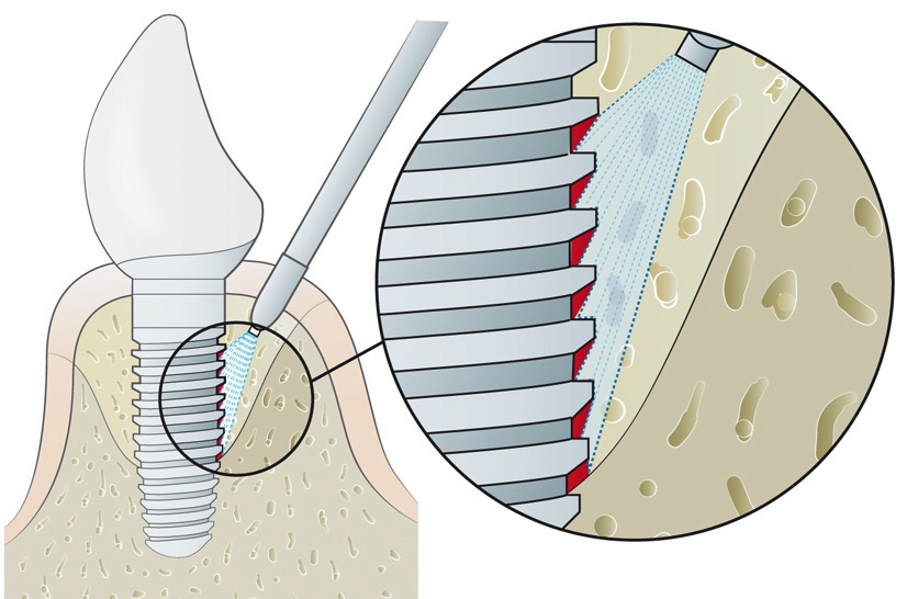 Abb. 1: An schraubenförmigen Implantaten sind einige Stellen, insbesondere in schmalen Defektkonfigurationen, mittels Pulverstrahlen nur schwer erreichbar. So kann sich beispielsweise die Unterseite der Gewindegänge in einem „Strahlschatten“ (rotgefärbt) befinden, was eine unzureichende Dekontamination dieser Stellen zur Folge hat.