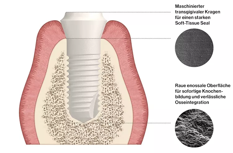 Abb. 2: Mit einem maschinierten transgingivalen und einem rauen enossalen Anteil verfügt das Patent™ Implantatsystem über eine speziellen Oberflächentopografie mit zwei unterschiedlichen Rautiefen, wodurch eine vorhersagbare und nachhaltige Integration in die Hart- und Weichgewebe erreicht wird.