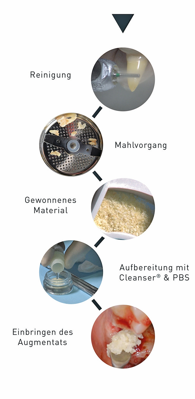 Abb. 2: Wird ein Zahn extrahiert, kann dieser nach dem Smart Grinder-Protokoll zu Knochenersatzmaterial aufbereitet und dadurch z. B. für eine Socket Preservation verwendet werden. Die Gesamtkosten für den Patienten betragen ca. 160 Euro, davon 100 Euro zahnärztliches Honorar.