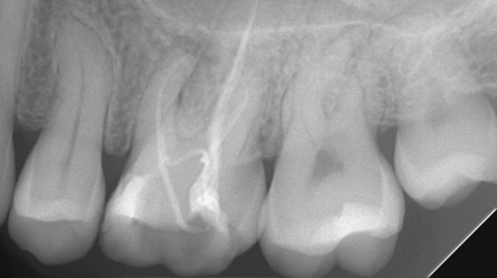 Abb. 2: Die palatinale Wurzel ist durchschnittlich 2 mm länger als die bukkale und steht vollends im Knochen, auch wenn die sagittal mittig/bukkalen Begrenzungen der Kieferhöhle durch die Gegenkortikalis im 2D-Bild eindeutig zu sehen sind.