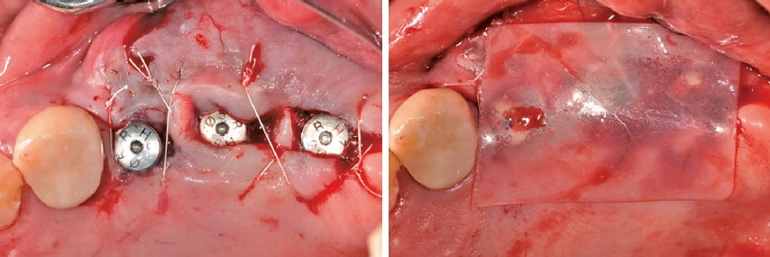 Ora-Aid in der Anwendung in der Implantatchirurgie.