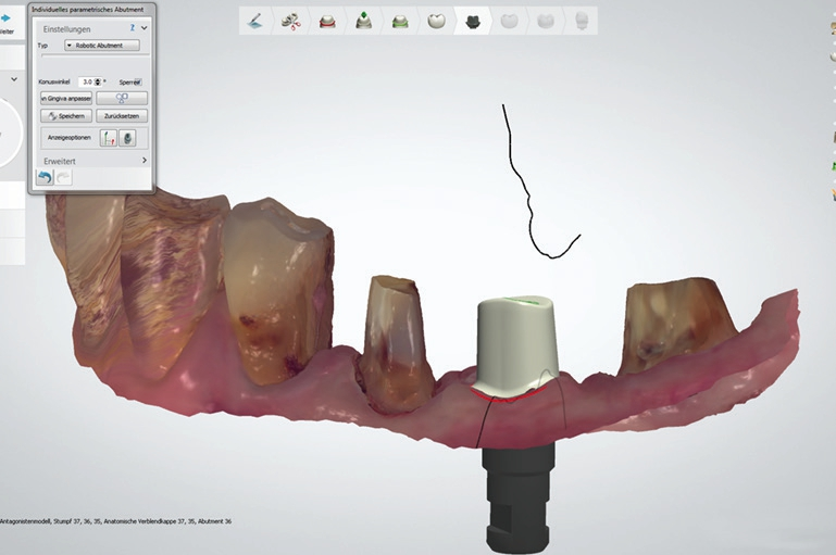 Abb. 3: …für die virtuelle Umsetzung des Abutments.