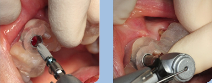 Abb. 2 u. 3: Vollnavigierte Implantatinsertion im ästhetischen Fenster mit korrekter dreidimensionaler Positionierung.