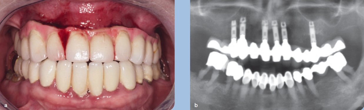 Abb. 2 a u. b: Massive Periimplantitiden bei implantatgetragener Oberkieferbrücke. Klinische Situation (a), Röntgenpanoramaschichtaufnahme (b).