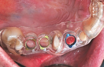 Abb. 2: Implantation mit Navigationsschablone.