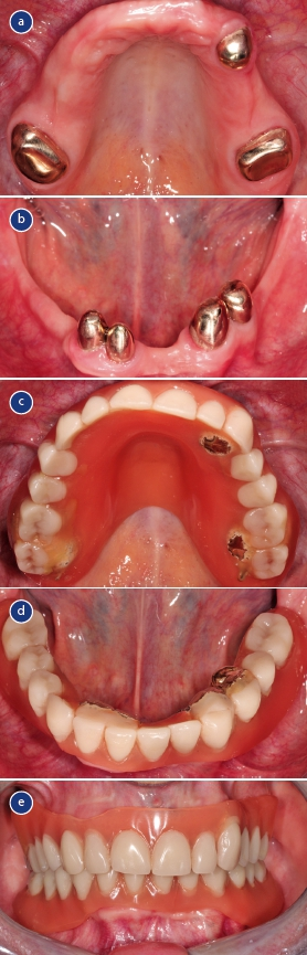 Abb. 2: Ausgangssituation der Patientin in Oberkiefer (a), Unterkiefer (b), 13 Jahre alte Prothese (c und d) und Gesamtansicht der eigentlichen Restauration (e).