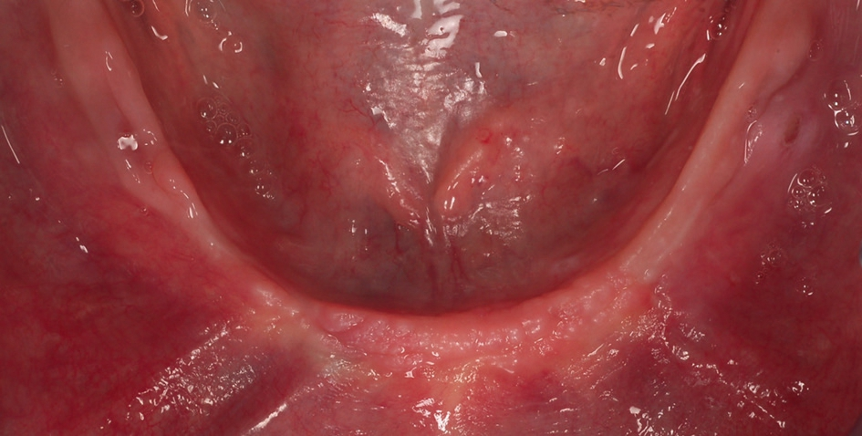 Abb. 3: Anfangssituation vor der Bildung eines Mukoperiostlappens zur Implantatinsertion, ausgeheilte Extraktionswunde regio 33.