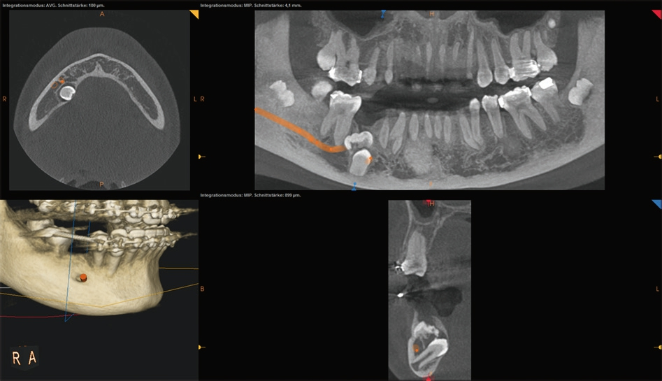 Abb. 1b: Darstellung einer überzähligen Zahnanlage und eines retinierten Zahnes 45 mit Markierung (orange) des Nervus alveolaris inferior; axial, coronal und sagittal.