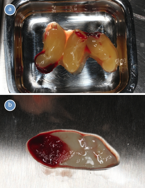 Abb. 2a und b: Fibrin-Clots nach dem Zentrifugieren des Patientenblutes (a) und L-PRF-Membran nach der Behandlung in der L-PRF-Box (b).