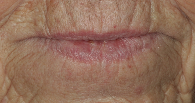 Abb. 2: Die prominente Altversorgung erzeugt aufgeworfene Lippen (vgl. mit der Neuversorgung in Abb. 30).