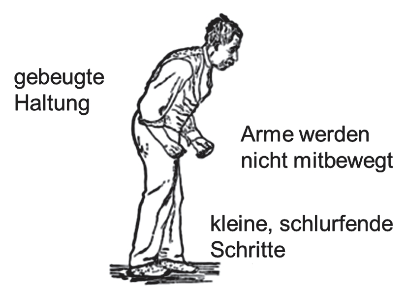 Abb. 2: Typische „Körpersprache“ beim Parkinson-Syndrom.