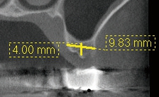 Abb. 2: Transversale CBCT-Aufnahme vor der Behandlung.