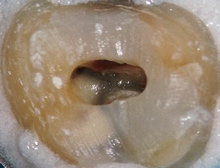 Abb. 2: Im Bereich des Eingangs zum mesiobukkalen Kanalsystem ist ein Dentinüberhang sichtbar, der den Zugang zu einem zweiten mesiobukkalen Wurzelkanal verlegt.