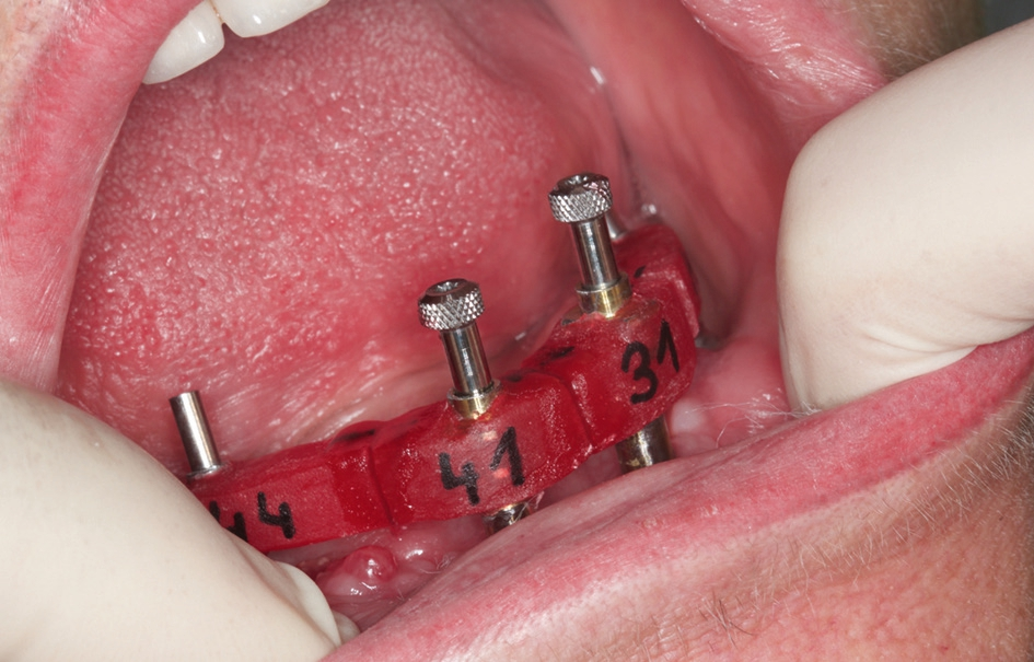 Abb. 2: Intraorales Verblocken der Abformpfosten.
