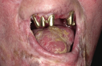 Abb. 2: Anzeichen für fortgeschrittene Gingivitis.