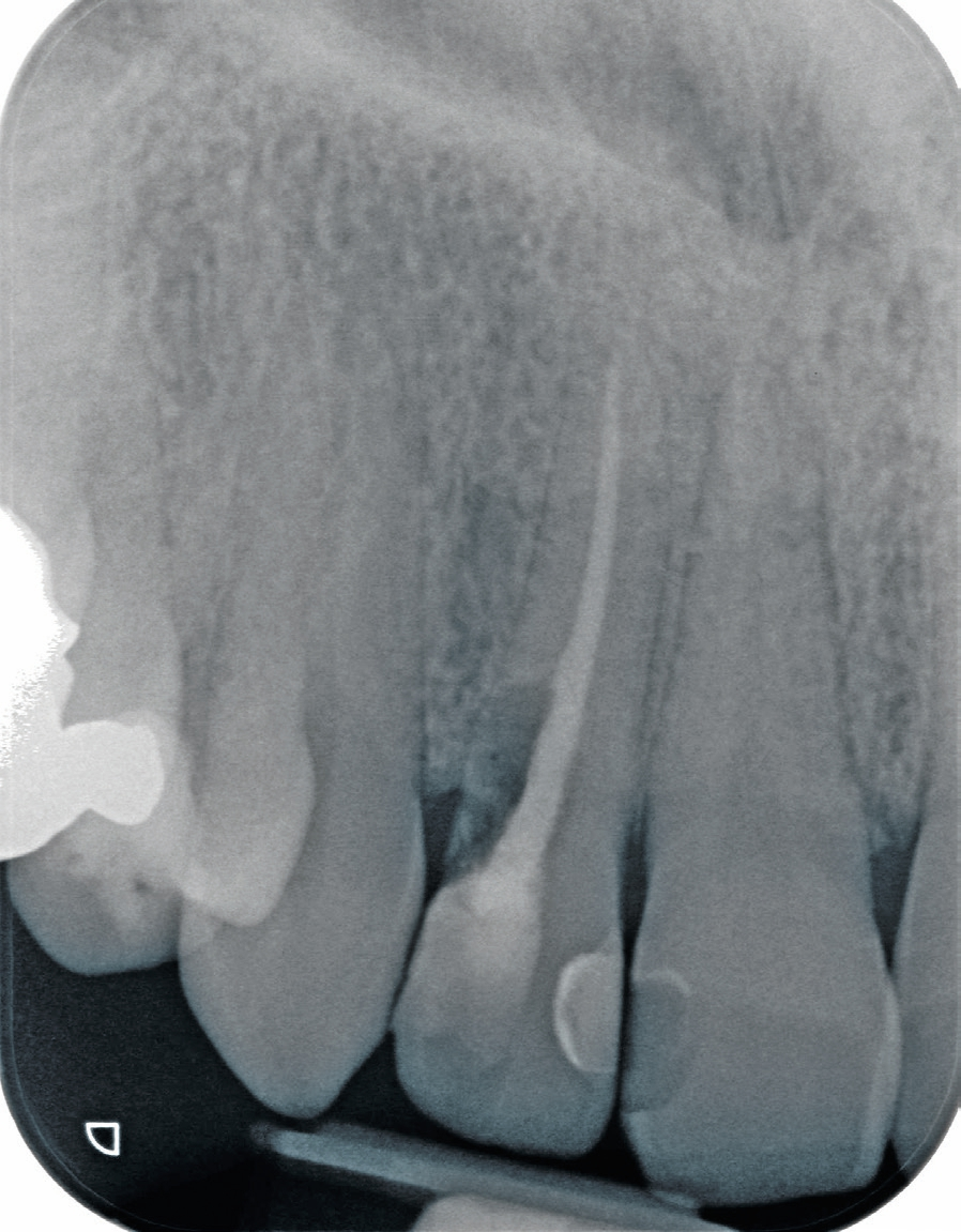 Abb. 2: Röntgenologisch sichtbare externe Resorption des wurzelkanalbehandelten Zahnes 12.